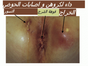 Copie de crohn lesions perianalesgif