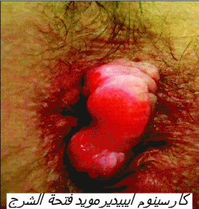 carcinome epdermoide de l'anus