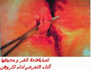 lesion anale et perianale crohn