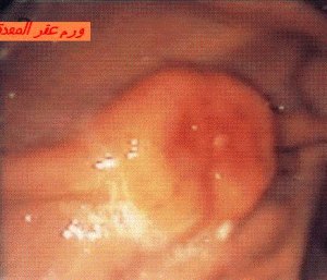 tumeur du fundus gastrique