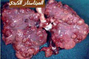 metastases hépatiques-1