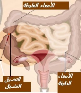 occlusion