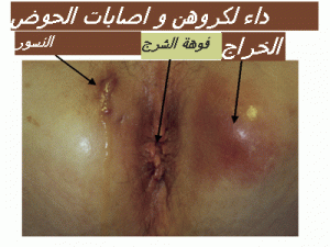 crohn lesions perianalesgif