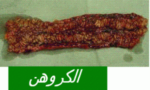 crohnلأ÷[