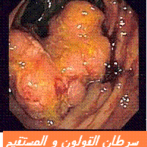 oCtober TERMINE Les Marqueurs sanguins tumoraux en cancérologie digestive  gastro casa procto casa-الدلائل الدموية المشخصة لأورام سرطان القناة الهضمية: