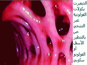 diverticulose