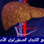 التشمع الكبدي الصفراوي الأصلي  Cirrhose biliaire primitive(CBP) hépato casa Gastro-entérologue, proctologue gastro casaa procto casa