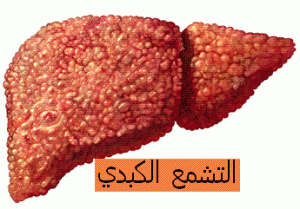 GP_CIRRHOSE1
