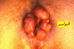 HEMORROIDES