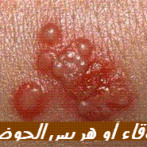 Douleurs proctologiques aiguës gastro casa procto casa ( 8ème partie) hepato الألآم الحادة لفتحة المخرج ( الجزء الثامن  )
