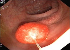 POLYP GASTRIQ