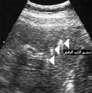 omete microlith hepatique