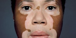 vitiligo