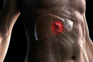 Liver cancer, computer artwork.