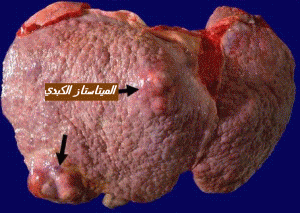 metastase hepatique 22
