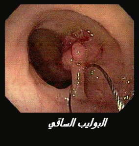 POLYPE PEDICULE