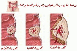 cancer colon
