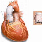 التهاب الأندوكارد (أو بطانة القلب الداخلية) الناجم عن العدوى و التشمع الكبدي الجزء الرابع – Endocardite infectieuse et Cirrhose4ème partie gastro casa