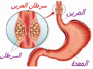 cancer oesop