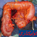 استراتيجية أخذ الموقف تجاه داء القولون التقرحي ( الجزء  الثاني) colectasie RCH               PRISE EN CHARGE DE LA RECTOCOLITE  HEMORRAGIQUE (RCH) (2ème PARTIE)RCH5 gastro casa procto casa