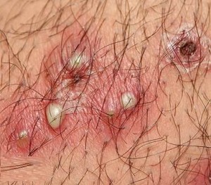 lymphogranulomatose venerienne1