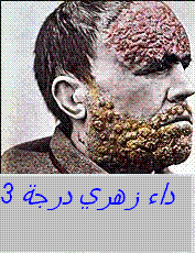 syphilis tertiare1