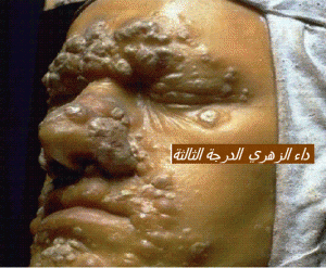 syphilis tertiare1