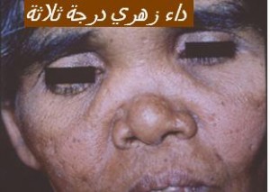 syphilis tertiazire5 tert