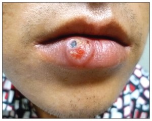 syphilis3