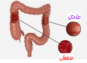 Colon-irritable1-500x325