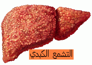 gp_cirrhose1