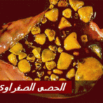 Obésité et la lithiase biliaireGastro-entérologue, proctologue الحصى الصفراوي و السمنةGastro-entérologue, proctologue gastro casa procto casa