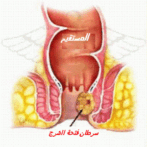 Le Papillome humain , condylomes , Crêtes de coq Gastro-entérologue, proctologue gastro casa procto casa الورم الحليمي