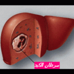 Cancer du foie – Carcinome hépatocellulaire (CHC) gastro casa Gastro-entérologue, proctologue gastro casa procto casa سرطان الكبد – كارسينوم الخلايا الكبدية