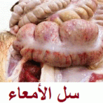 La tuberculose intestinale – االجزء الرابع  4ème partie –    سل المعدة و ألأمعاء