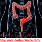 Quelle est la place du taux de détection des adénomes dans le dépistage organisé du cancer colorectal ? Docteur AMINE Abdelkader  gastro casa procto casa gastro entérologue casa  أين نحن اليوم من تشخيص الأورام الأدينومية أو الغدية الحميدة أثناءحملة الكشف المنتظم لسرطان القولون و المستقيم ؟