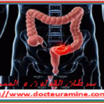 سرطان القولون و المستقيم : الأمر الذي يغير ممارستنا الطبيةCancer colorectal : ce qui change nos pratiques Cancer colorectal : ce qui change nos pratiques    Partie 18 الجزء الثامن عشر  GASTRO CASA PROCTO CASA يتابع