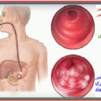 Eradication systémique de Helicobacter pylori en prévention du cancer gastrique : Qu’en sommes-nous ?الانقراض المنتظم لجرثومة هيليكوباكتير بلوري كوقاية ضد الإصابةPartie 5 الجزء الخامس