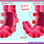Diverticulose du grêle : diagnostic et prise en charge دبفيرتيكولوز أو داء ردج الأمعاء الدقيقة : التشخيص و أخذ الموقف- Partie 4 الجزء الرابع