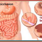 Diverticulose du grêle : diagnostic et prise en charge دبفيرتيكولوز أو داء ردج الأمعاء الدقيقة : التشخيص و أخذ الموقف- Partie 7 الجزء السابع