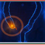 Diverticulose du grêle : diagnostic et prise en charge دبفيرتيكولوز أو داء ردج الأمعاء الدقيقة : التشخيص و أخذ الموقف- Partie 8 الجزء الثامن