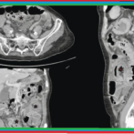 Diverticulose du grêle : diagnostic et prise en charge دبفيرتيكولوز أو داء ردج الأمعاء الدقيقة : التشخيص و أخذ الموقف- Partie 11 الجزء الحادي عشر