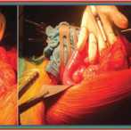 Diverticulose du grêle : diagnostic et prise en charge دبفيرتيكولوز أو داء ردج الأمعاء الدقيقة : التشخيص و أخذ الموقف- Partie 14 الجزء الرابع عشر