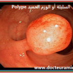 سبل المراقبة بعد استئصال السليلة القولونيةModalités de surveillance après polypectomie colique  Gastro casa – Procto casa Partie 1 الجزء الأول