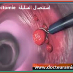 سبل المراقبة بعد استئصال السليلة القولونيةModalités de surveillance après polypectomie colique  Gastro casa – Procto casa Partie 1 الجزء الأول