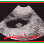 الأورام االحميدة الحويصلية : التشخيص و و أخذ الموقف. Polypes vésiculaires : diagnostic et prise en charge. – -Partie 3 الجزءالثالث