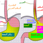 علاج الجزر أو الارتجاع المعدي المريئي بواسطة مثبطات مضخة البروتون: الوصايا والممارسةTraitement de Reflux gastro-œsophagien par les inhibiteurs de la pompe à protons : les recommandations et la pratique