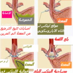 علاج الجزر أو الارتجاع المعدي المريئي بواسطة مثبطات مضخة البروتون: الوصايا والممارسةTraitement de Reflux gastro-œsophagien par les inhibiteurs de la pompe à protons : les recommandations et la pratique  الجزء السادس  Partie 6 يتابع