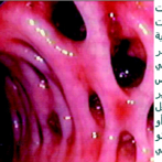 التاريخ الطبيعي لداء الرتج القولوني – مرض الرتج L’Histoire naturelle de la diverticulose colique – maladie diverticulaire    يتابعPartie 8 الجزء الثامن