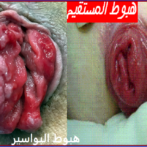 حقيقة دور التوابل في مرض البواسير – GASTRO CASTRO CASA PROCTO gastroentérologue casa -ECHOENDOSCOPIE